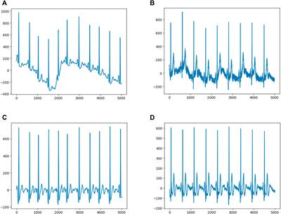 Development and Validation of a Deep-Learning Model to Detect CRP Level from the Electrocardiogram